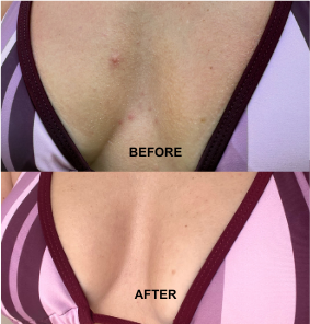 Chest before and after using AHA BHA body serum