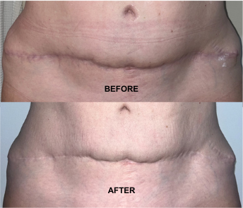 Post-op scar before and after using Goddess of Youth